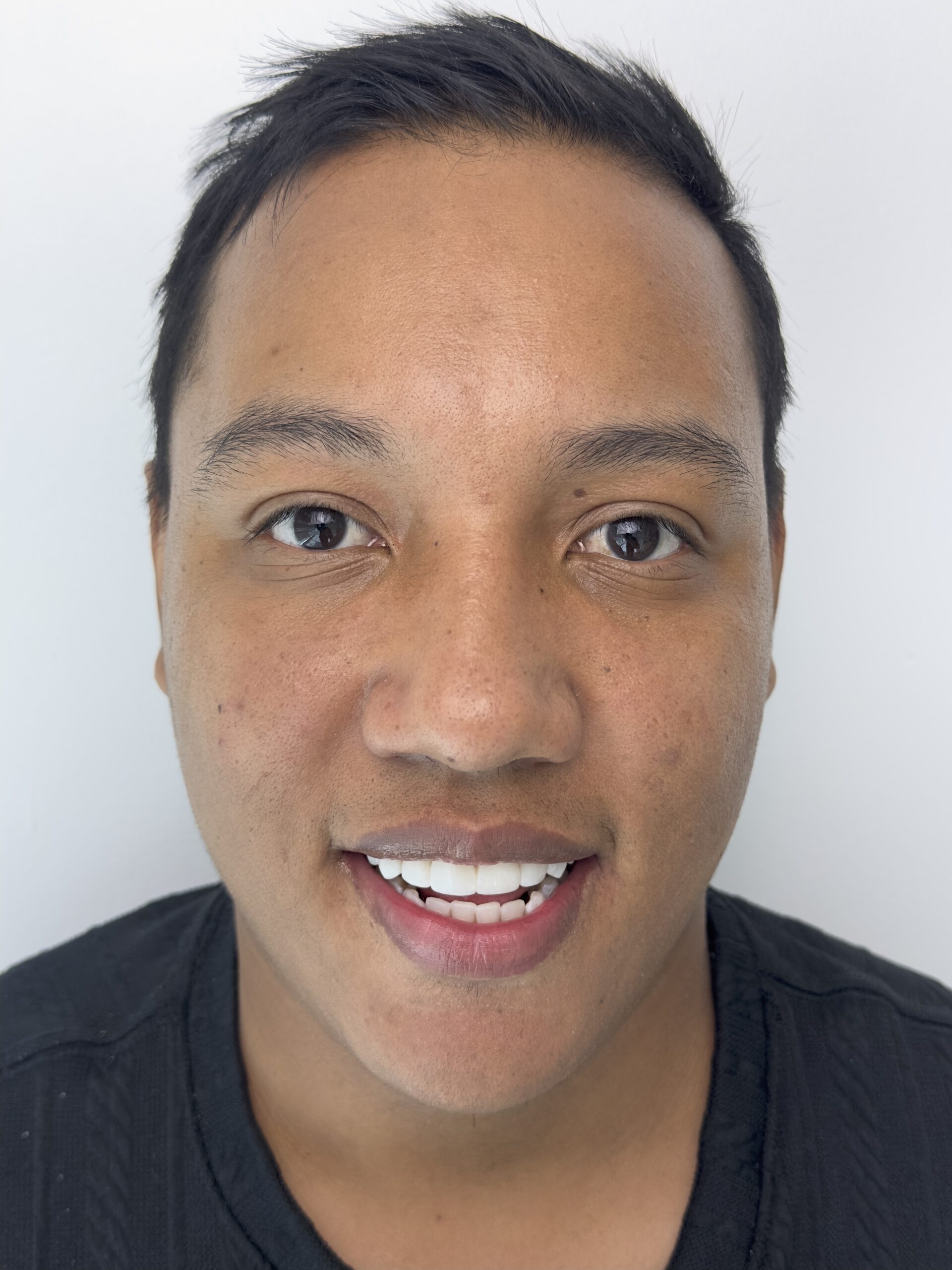 after porcelain veneers