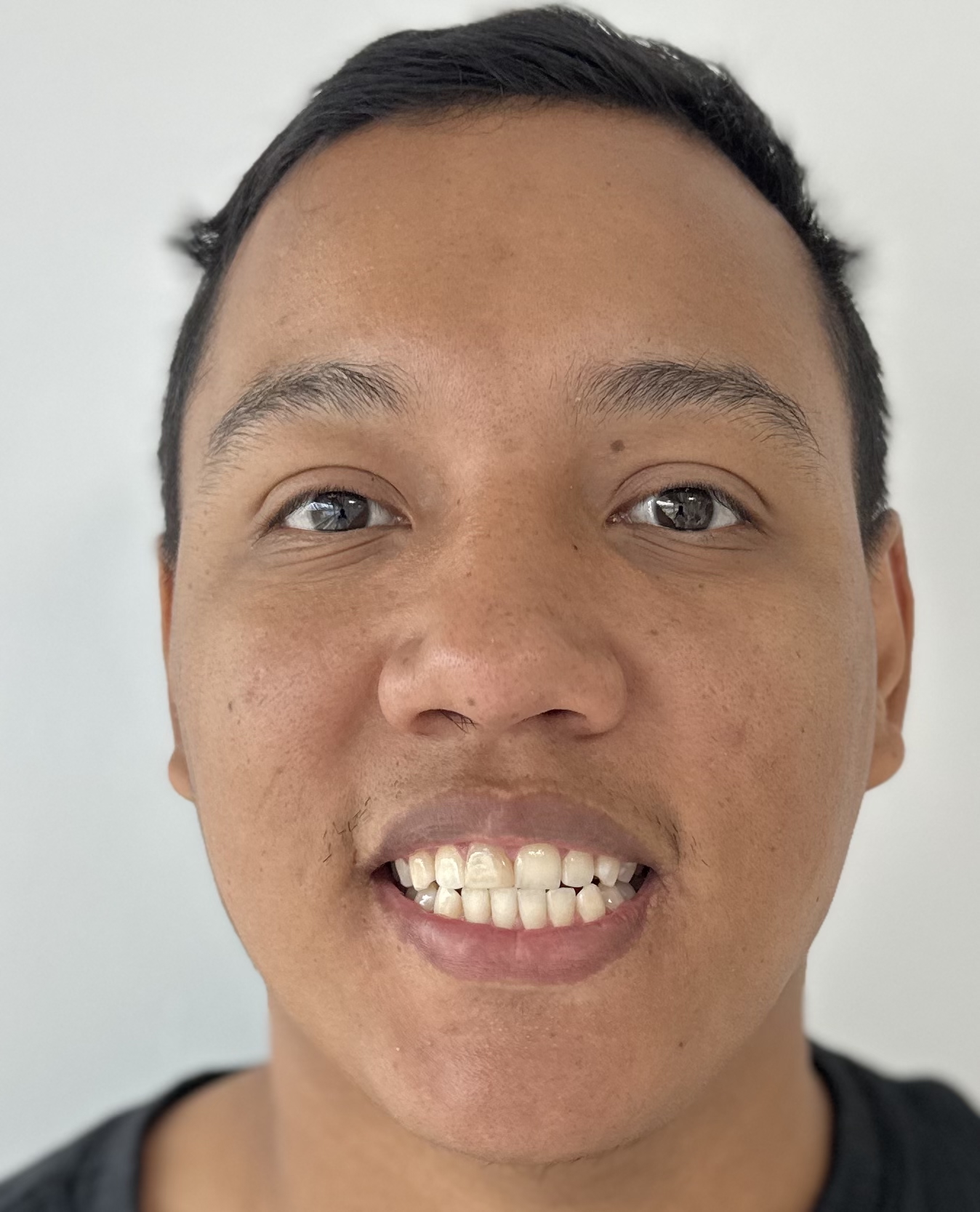 before porcelain veneers image