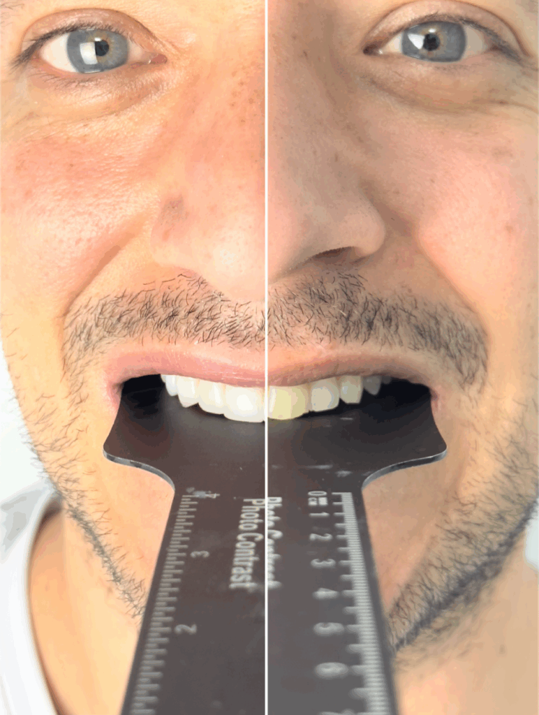 image before after ceramic veneers