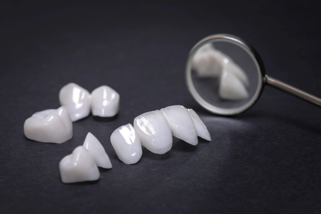 porcelain veneers image