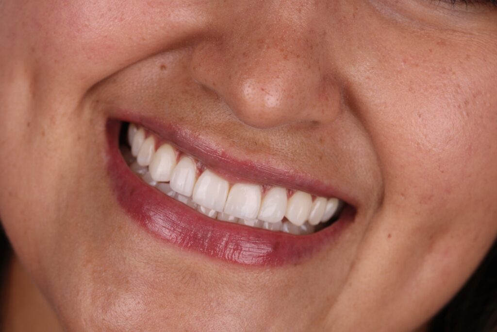 Diseño de Sonrisa