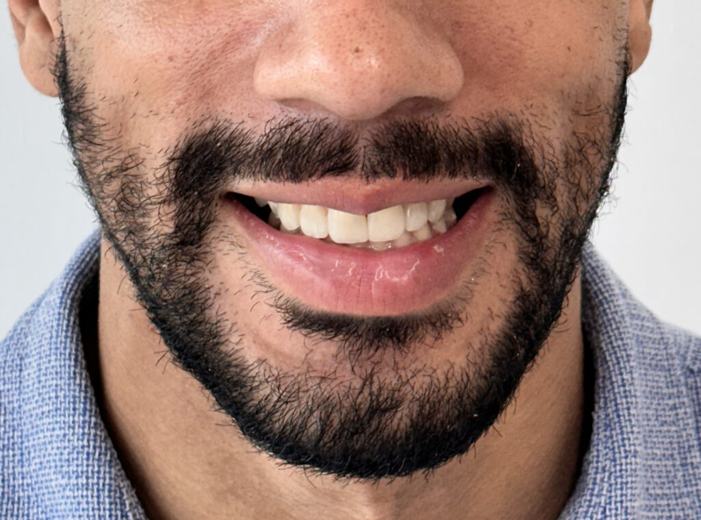 Implantes Dentales en Medellín