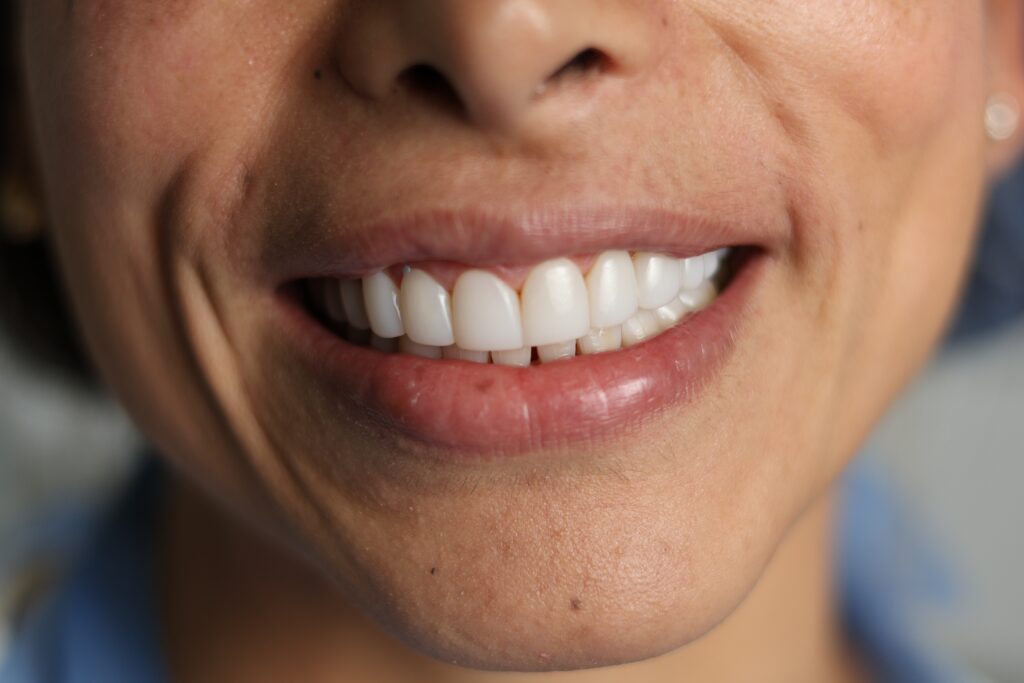 Implantes Dentales en Medellín