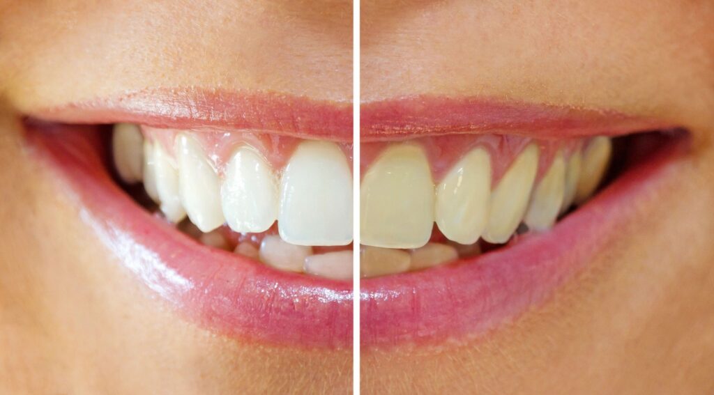antes despues diseño de sonrisa